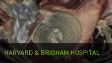 Harvard y el hospital Brigham: placa arterial